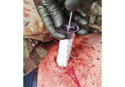 Injecting XSTAT's large syringe of sponges into a severe wound stops hemorrhaging within 15 to 20 seconds. (Photo: RevMedx)