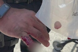 A homeless man bit off part of an LAPD officer's finger Thursday during an altercation on a Metro platform.
