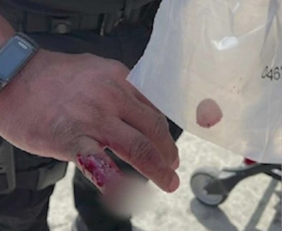 A homeless man bit off part of an LAPD officer's finger Thursday during an altercation on a Metro platform.